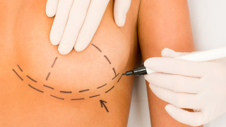 FDA Warned About Dangers Of French Breast Implants, But No One Listened